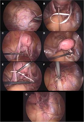Modified Oxford technique of colpopexy for the treatment of uterine and vaginal vault prolapse: a retrospective pilot cohort study